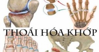 Thoái hóa khớp là gì? Triệu chứng, nguyên nhân gây bệnh